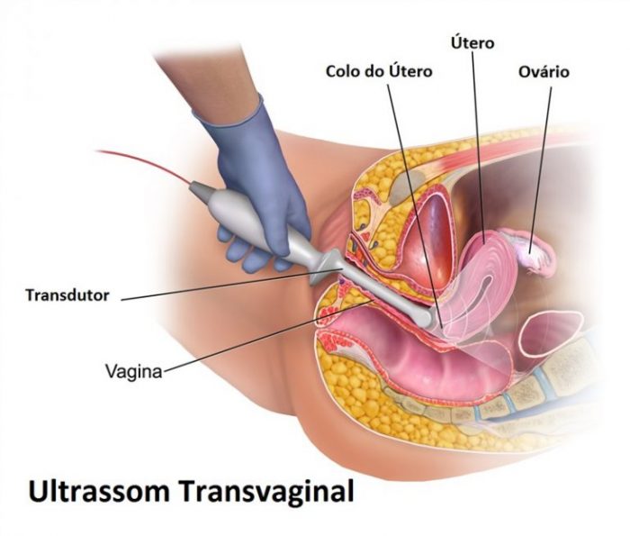 Ecografia transvaginal mostrando ovário de aspecto normal, com a