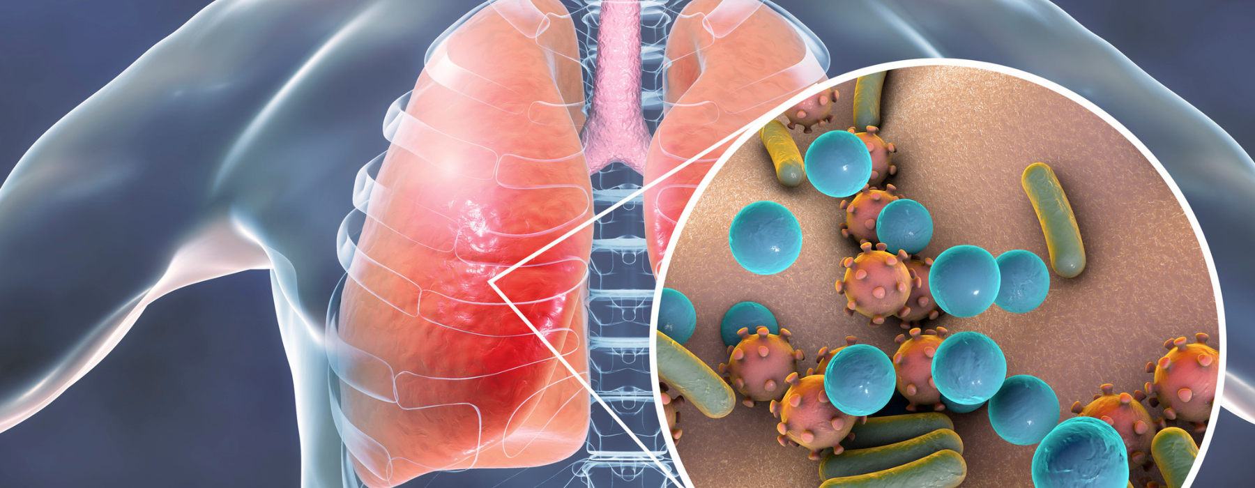 Pneumonia: o que é e qual o melhor tratamento