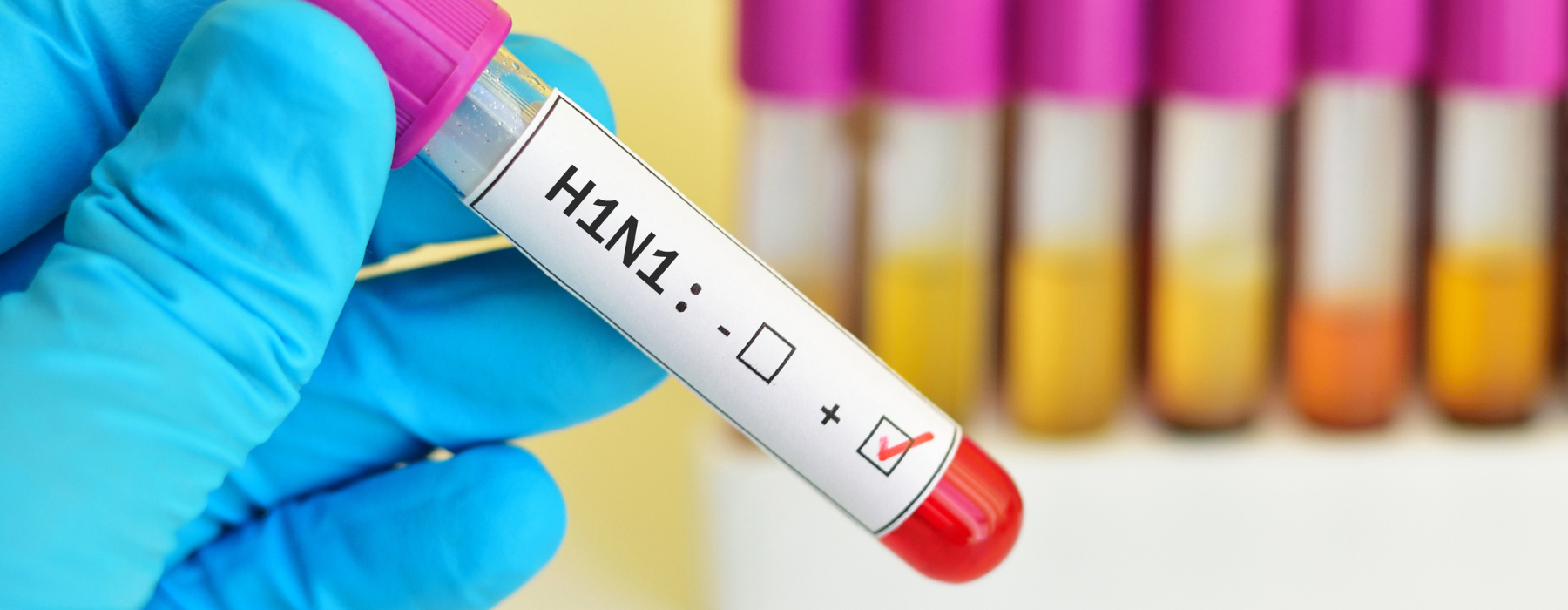 H1N1: o que é, como é feito o diagnóstico e a relação com a broncopneumonia