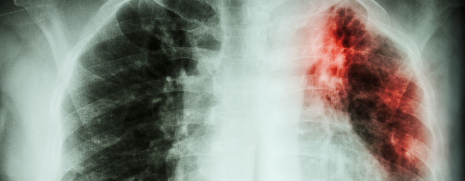 Tromboembolismo pulmonar: o que é, como diagnosticar e tratar